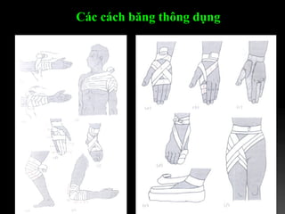 Các cách băng thông dụng   