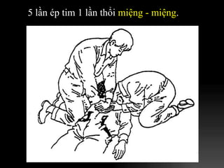 5 lần ép tim 1 lần thổi  miệng - miệng . 