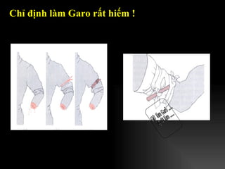 Chỉ định làm Garo rất hiếm ! Giờ  làm Garô ..... Người làm ..... 