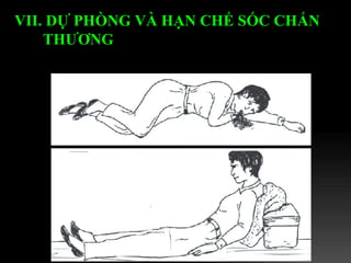 VII. DỰ PHÒNG VÀ HẠN CHẾ SỐC CHẤN THƯƠNG   
