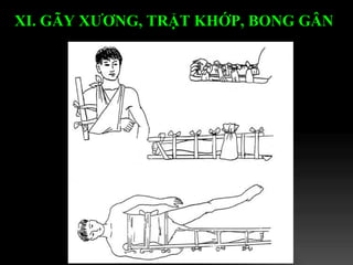 XI. GÃY XƯƠNG, TRẬT KHỚP, BONG GÂN   