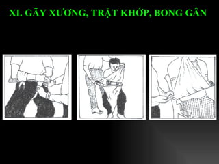 XI. GÃY XƯƠNG, TRẬT KHỚP, BONG GÂN   