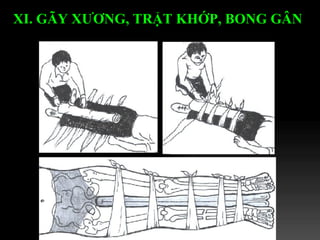 XI. GÃY XƯƠNG, TRẬT KHỚP, BONG GÂN   