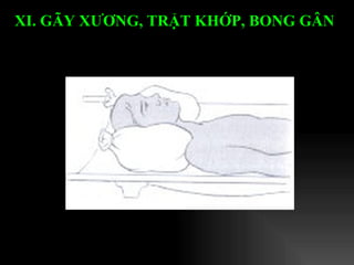 XI. GÃY XƯƠNG, TRẬT KHỚP, BONG GÂN   