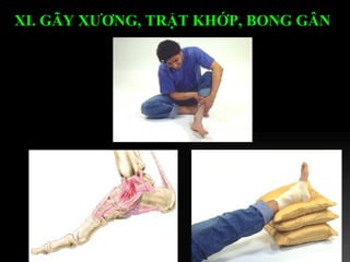 XI. GÃY XƯƠNG, TRẬT KHỚP, BONG GÂN   
