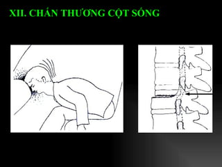 XII. CHẤN THƯƠNG CỘT SỐNG   