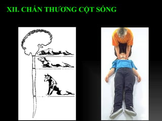 XII. CHẤN THƯƠNG CỘT SỐNG   