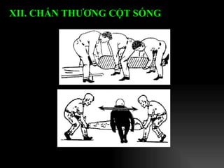 XII. CHẤN THƯƠNG CỘT SỐNG   