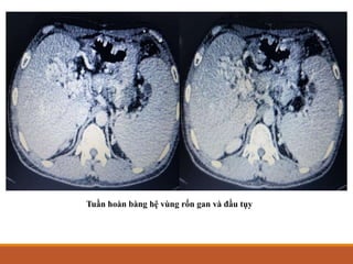QUY TRÌNH ĐỌC CT BUNG- DR TRUONG.pdf