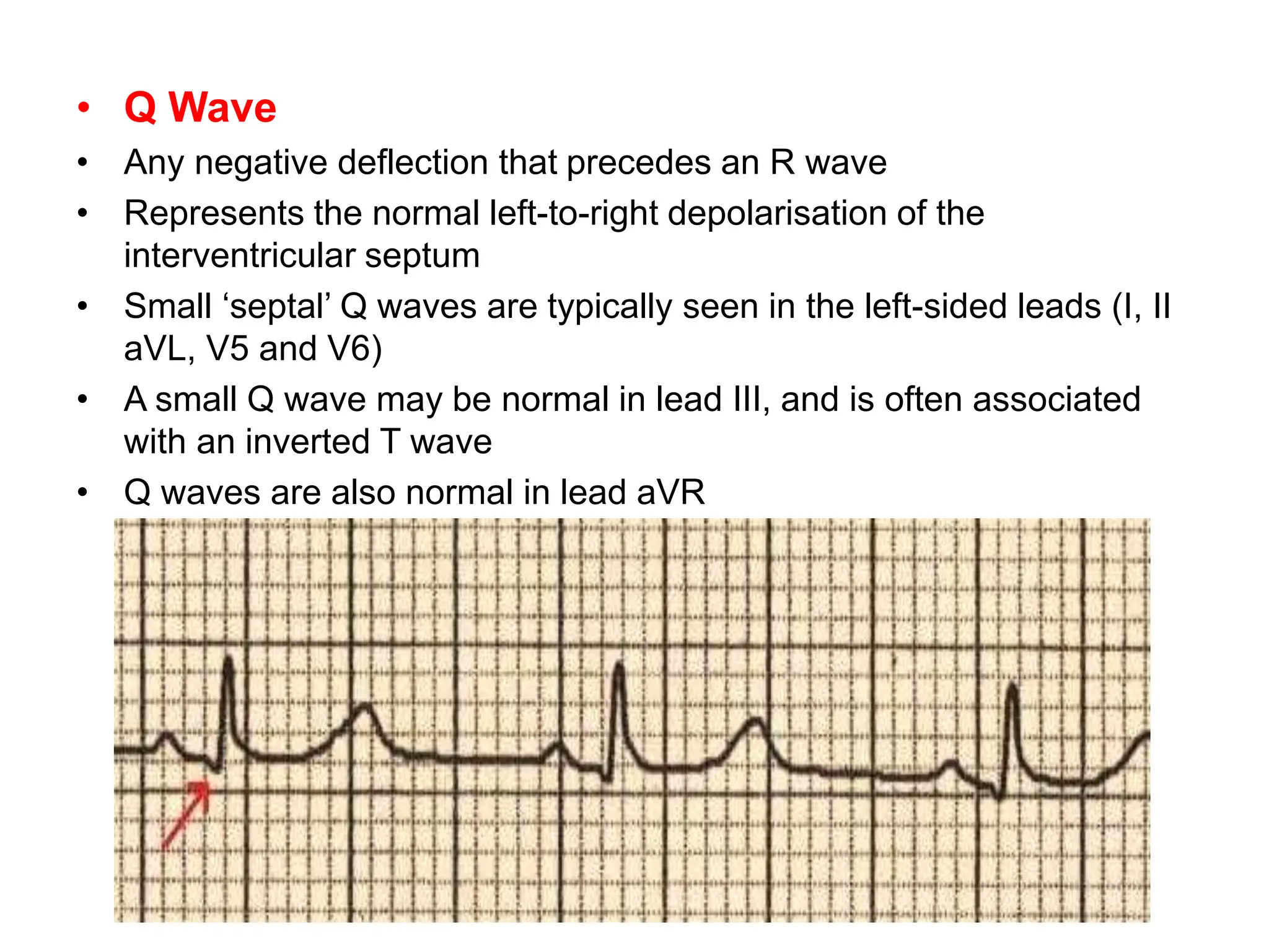 Q WAVE IN ECG CAUSES OF PATHOLOGICAL Q WAVES PPTX Q WAVE IN ECG CAUSES OF PATHOLOGICAL Q WAVES PPTX