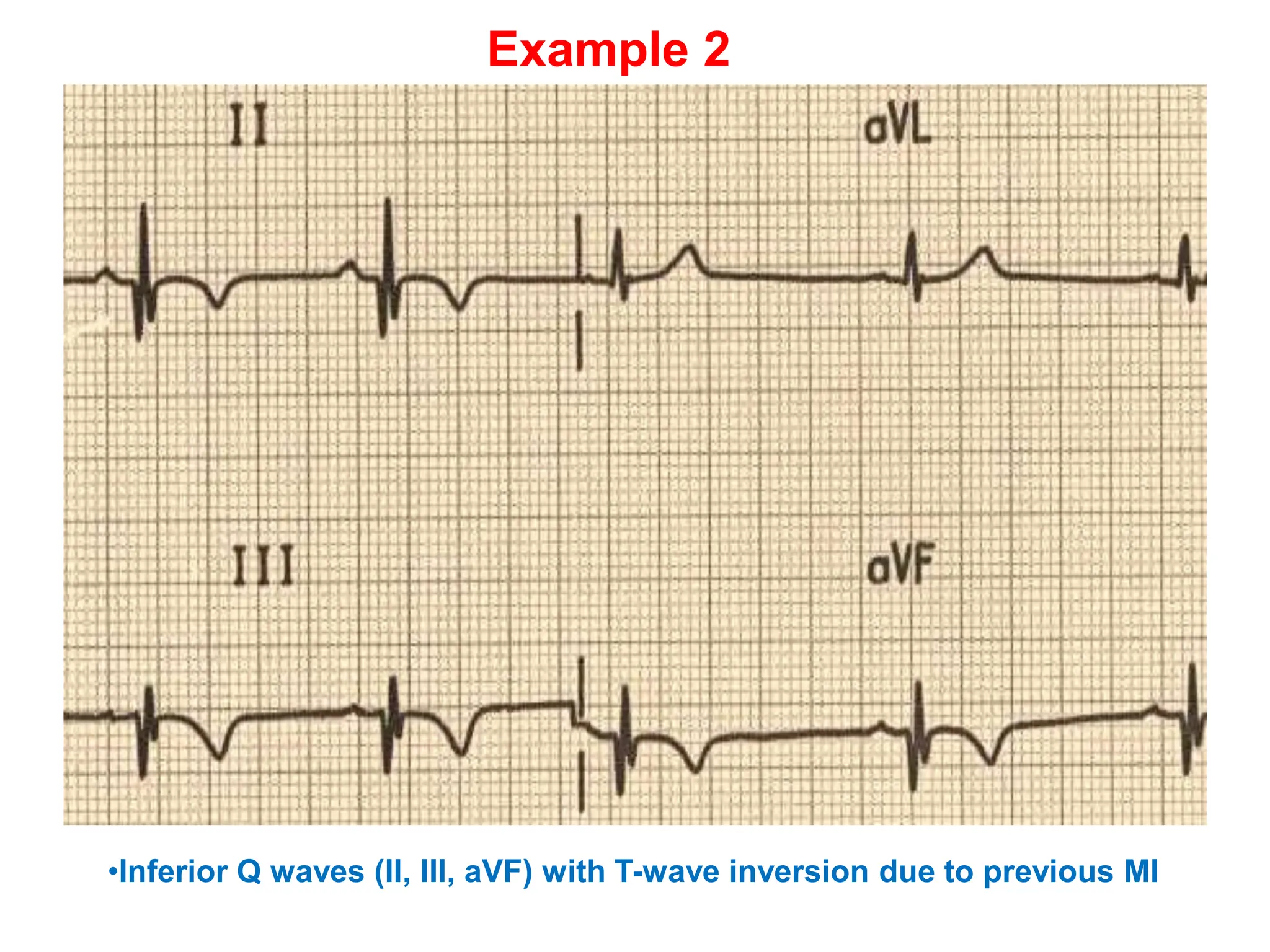 Q WAVE IN ECG CAUSES OF PATHOLOGICAL Q WAVES PPTX Q WAVE IN ECG CAUSES OF PATHOLOGICAL Q WAVES PPTX