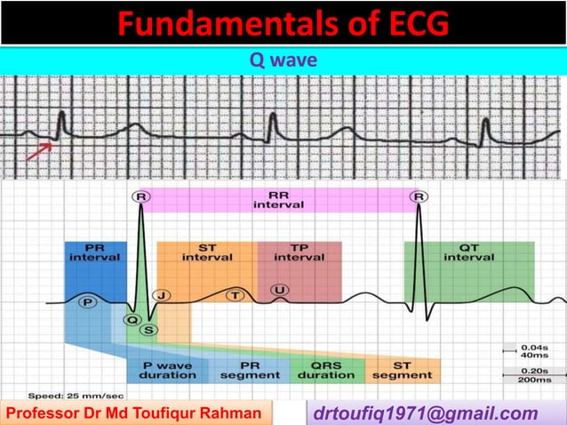 Approach to a patient with Q wave abnormality in ECG | PPT