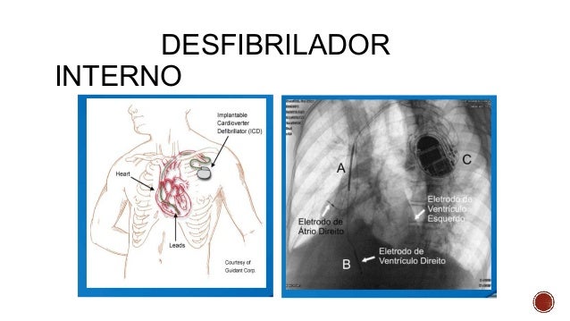 Desfibrilacioin Cardioversion