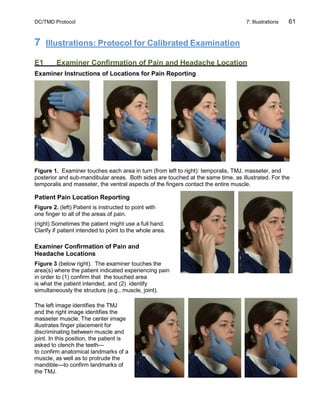 DC/TMD Protocol 7: Illustrations 61
7 Illustrations: Protocol for Calibrated Examination
E1 Examiner Confirmation of Pain and Headache Location
Examiner Instructions of Locations for Pain Reporting
Figure 1. Examiner touches each area in turn (from left to right): temporalis, TMJ, masseter, and
posterior and sub-mandibular areas. Both sides are touched at the same time, as illustrated. For the
temporalis and masseter, the ventral aspects of the fingers contact the entire muscle.
Patient Pain Location Reporting
Figure 2. (left) Patient is instructed to point with
one finger to all of the areas of pain.
(right) Sometimes the patient might use a full hand.
Clarify if patient intended to point to the whole area.
Examiner Confirmation of Pain and
Headache Locations
Figure 3 (below right). The examiner touches the
area(s) where the patient indicated experiencing pain
in order to (1) confirm that the touched area
is what the patient intended, and (2) identify
simultaneously the structure (e.g., muscle, joint).
The left image identifies the TMJ
and the right image identifies the
masseter muscle. The center image
illustrates finger placement for
discriminating between muscle and
joint. In this position, the patient is
asked to clench the teeth—
to confirm anatomical landmarks of a
muscle, as well as to protrude the
mandible—to confirm landmarks of
the TMJ.
 