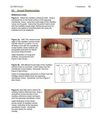 DC/TMD Protocol 7: Illustrations 62
E2 Incisal Relationships
Reference Lines
Figure 4. Select the maxillary reference tooth. Draw a
horizontal line on the facial surface of the opposing
mandibular incisor, using the incisal edge of the maxillary
incisor as the guide. Insure that the pencil mark is level
with the maxillary incisal edge; holding the pencil at an
angle to the patient’s horizontal plane will cause the
overbite line to be displaced.
Figure 5a. (left) The mesial-incisal
edge of the maxillary central incisor
(US #8, FDI #11) is within 1.0 mm
of being in line with the mandibular
incisal midline; these midlines are
acceptable landmarks for lateral
excursive measurements.
(right) Illustration of congruent
midlines; horizontal line from
Figure 4 also shown..
Figure 5b. (left) Mesial-incisal edge of the maxillary
central incisor is more than 1.0mm away from the
mandibular incisal midline. Horizontal line from
Figure 4 also shown.
(right) A corresponding vertical line is drawn from the
maxillary dental midline down the opposing
mandibular incisor. Horizontal line from Figure 4
also shown.
Figure 6. (left) Alternative method for
creating midline reference lines: draw a
vertical line across the face of the
maxillary reference incisor and down
onto the opposing mandibular incisor.
(right) Illustration of line drawn
across center of maxillary central
incisor, extending to the opposing
mandibular incisor. Horizontal
line also shown for vertical
overlap.
 