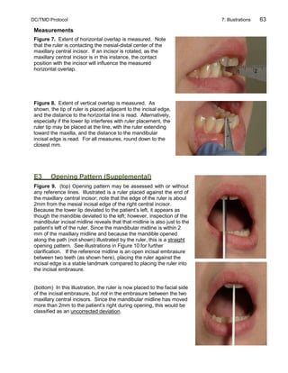 DC/TMD Protocol 7: Illustrations 63
Measurements
Figure 7. Extent of horizontal overlap is measured. Note
that the ruler is contacting the mesial-distal center of the
maxillary central incisor. If an incisor is rotated, as the
maxillary central incisor is in this instance, the contact
position with the incisor will influence the measured
horizontal overlap.
Figure 8. Extent of vertical overlap is measured. As
shown, the tip of ruler is placed adjacent to the incisal edge,
and the distance to the horizontal line is read. Alternatively,
especially if the lower lip interferes with ruler placement, the
ruler tip may be placed at the line, with the ruler extending
toward the maxilla, and the distance to the mandibular
incisal edge is read. For all measures, round down to the
closest mm.
E3 Opening Pattern (Supplemental)
Figure 9. (top) Opening pattern may be assessed with or without
any reference lines. Illustrated is a ruler placed against the end of
the maxillary central incisor; note that the edge of the ruler is about
2mm from the mesial incisal edge of the right central incisor.
Because the lower lip deviated to the patient’s left, it appears as
though the mandible deviated to the left; however, inspection of the
mandibular incisal midline reveals that that midline is also just to the
patient’s left of the ruler. Since the mandibular midline is within 2
mm of the maxillary midline and because the mandible opened
along the path (not shown) illustrated by the ruler, this is a straight
opening pattern. See illustrations in Figure 10 for further
clarification. If the reference midline is an open incisal embrasure
between two teeth (as shown here), placing the ruler against the
incisal edge is a stable landmark compared to placing the ruler into
the incisal embrasure.
(bottom) In this illustration, the ruler is now placed to the facial side
of the incisal embrasure, but not in the embrasure between the two
maxillary central incisors. Since the mandibular midline has moved
more than 2mm to the patient’s right during opening, this would be
classified as an uncorrected deviation.
 