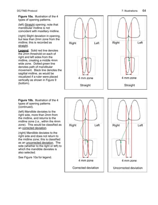 DC/TMD Protocol 7: Illustrations 64
Figure 10a. Illustration of the 4
types of opening patterns.
(left) Straight opening; note that
mandibular midline is not
coincident with maxillary midline.
(right) Slight deviation in opening,
but less than 2mm zone from the
midline; this is recorded as
straight.
Legend. Solid red line denotes
the 2mm threshold on each of
right and left sides from the
midline, creating a middle 4mm
wide zone. Dotted green line
denotes path of mandibular
movement. Black line denotes the
sagittal midline, as would be
visualized if a ruler were placed
vertically as shown in Figure 9
(bottom).
Figure 10b. Illustration of the 4
types of opening patterns
(continued).
(left) Mandible deviates to the
right side, more than 2mm from
the midline, and returns to the
midline zone (i.e., within the 4mm
zone). This would be classified as
an corrected deviation.
(right) Mandible deviates to the
right side and does not return to
the midline zone; this is classified
as an uncorrected deviation. The
side (whether to the right or left) to
which the mandible deviates is
also selected.
See Figure 10a for legend.
 