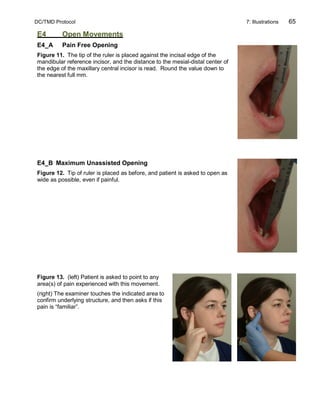 DC/TMD Protocol 7: Illustrations 65
E4 Open Movements
E4_A Pain Free Opening
Figure 11. The tip of the ruler is placed against the incisal edge of the
mandibular reference incisor, and the distance to the mesial-distal center of
the edge of the maxillary central incisor is read. Round the value down to
the nearest full mm.
E4_B Maximum Unassisted Opening
Figure 12. Tip of ruler is placed as before, and patient is asked to open as
wide as possible, even if painful.
Figure 13. (left) Patient is asked to point to any
area(s) of pain experienced with this movement.
(right) The examiner touches the indicated area to
confirm underlying structure, and then asks if this
pain is “familiar”.
 
