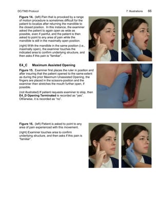 DC/TMD Protocol 7: Illustrations 66
Figure 14. (left) Pain that is provoked by a range
of motion procedure is sometimes difficult for the
patient to localize after returning the mandible to
the closed position. In this instance, the examiner
asked the patient to again open as wide as
possible, even if painful, and the patient is then
asked to point to any area of pain while the
mandible is still in the maximally open position.
(right) With the mandible in the same position (i.e.,
maximally open), the examiner touches the
indicated area to confirm underlying structure, and
then asks if this pain is “familiar”.
E4_C Maximum Assisted Opening
Figure 15. Examiner first places the ruler in position and
after insuring that the patient opened to the same extent
as during the prior Maximum Unassisted Opening, the
fingers are placed in the scissors-position and the
examiner then stretches the mouth further open, if
possible.
(not illustrated) If patient requests examiner to stop, then
E4_D Opening Terminated is recorded as “yes”.
Otherwise, it is recorded as “no”.
Figure 16. (left) Patient is asked to point to any
area of pain experienced with this movement.
(right) Examiner touches area to confirm
underlying structure, and then asks if this pain is
“familiar”.
 