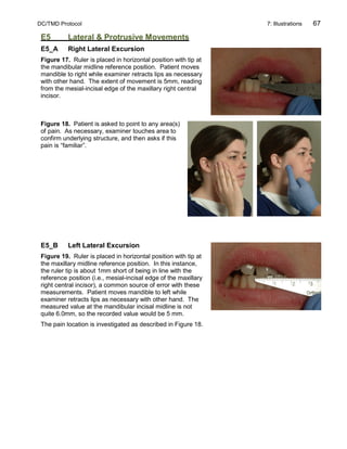 DC/TMD Protocol 7: Illustrations 67
E5 Lateral & Protrusive Movements
E5_A Right Lateral Excursion
Figure 17. Ruler is placed in horizontal position with tip at
the mandibular midline reference position. Patient moves
mandible to right while examiner retracts lips as necessary
with other hand. The extent of movement is 5mm, reading
from the mesial-incisal edge of the maxillary right central
incisor.
Figure 18. Patient is asked to point to any area(s)
of pain. As necessary, examiner touches area to
confirm underlying structure, and then asks if this
pain is “familiar”.
E5_B Left Lateral Excursion
Figure 19. Ruler is placed in horizontal position with tip at
the maxillary midline reference position. In this instance,
the ruler tip is about 1mm short of being in line with the
reference position (i.e., mesial-incisal edge of the maxillary
right central incisor), a common source of error with these
measurements. Patient moves mandible to left while
examiner retracts lips as necessary with other hand. The
measured value at the mandibular incisal midline is not
quite 6.0mm, so the recorded value would be 5 mm.
The pain location is investigated as described in Figure 18.
 