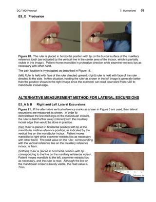DC/TMD Protocol 7: Illustrations 68
E5_C Protrusion
Figure 20. The ruler is placed in horizontal position with tip on the buccal surface of the maxillary
reference tooth (as indicated by the vertical line in the center area of the incisor, which is partially
visible in this image). Patient moves mandible in protrusive direction while examiner retracts lips as
necessary with other hand.
The pain location is investigated as described in Figure 18.
(left) Ruler is held with face of the ruler directed upward; (right) ruler is held with face of the ruler
directed to the side. In this situation, holding the ruler as shown in the left image is generally better
than the position shown in the right image since the examiner can read downward from ruler to
mandibular incisal edge.
ALTERNATIVE MEASUREMENT METHOD FOR LATERAL EXCURSIONS
E5_A & B Right and Left Lateral Excursions
Figure 21. If the alternative vertical reference marks as shown in Figure 6 are used, then lateral
excursions are measured as shown. In order to
demonstrate the line markings on the mandibular incisors,
the ruler is held further away (inferior) from the maxillary
incisal edge than would be done in practice.
(top) Ruler is placed in horizontal position with tip at the
mandibular midline reference position, as indicated by the
vertical line on the mandibular incisor. Patient moves
mandible to right while examiner retracts lips as necessary
with other hand. The read value on the ruler, corresponding
with the vertical reference line on the maxillary reference
incisor, is 7mm.
(bottom) Ruler is placed in horizontal position with tip
corresponding to the line on the maxillary reference incisor.
Patient moves mandible to the left, examiner retracts lips
as necessary, and the ruler is read. Although the line on
the mandibular incisor is barely visible, the read value is
7mm.
 