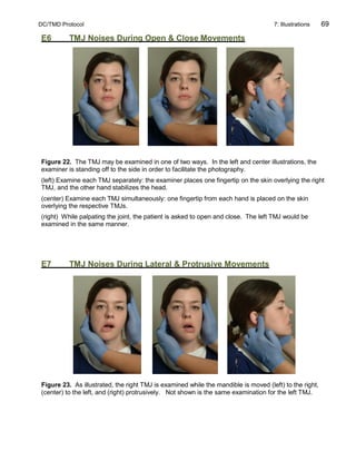 DC/TMD Protocol 7: Illustrations 69
E6 TMJ Noises During Open & Close Movements
Figure 22. The TMJ may be examined in one of two ways. In the left and center illustrations, the
examiner is standing off to the side in order to facilitate the photography.
(left) Examine each TMJ separately: the examiner places one fingertip on the skin overlying the right
TMJ, and the other hand stabilizes the head.
(center) Examine each TMJ simultaneously: one fingertip from each hand is placed on the skin
overlying the respective TMJs.
(right) While palpating the joint, the patient is asked to open and close. The left TMJ would be
examined in the same manner.
E7 TMJ Noises During Lateral & Protrusive Movements
Figure 23. As illustrated, the right TMJ is examined while the mandible is moved (left) to the right,
(center) to the left, and (right) protrusively. Not shown is the same examination for the left TMJ.
 