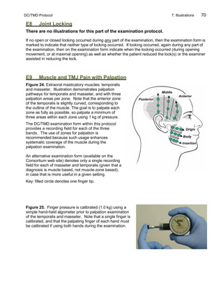 DC/TMD Protocol 7: Illustrations 70
E8 Joint Locking
There are no illustrations for this part of the examination protocol.
If no open or closed locking occurred during any part of the examination, then the examination form is
marked to indicate that neither type of locking occurred. If locking occurred, again during any part of
the examination, then on the examination form indicate when the locking occurred (during opening
movement, or at maximal opening) as well as whether the patient reduced the lock(s) or the examiner
assisted in reducing the lock.
E9 Muscle and TMJ Pain with Palpation
Figure 24. Extraoral masticatory muscles: temporalis
and masseter. Illustration demonstrates palpation
pathways for temporalis and masseter, and with three
palpation areas per zone. Note that the anterior zone
of the temporalis is slightly curved, corresponding to
the outline of the muscle. The goal is to palpate each
zone as fully as possible, so palpate a minimum of
three areas within each zone using 1 kg of pressure.
The DC/TMD examination form within this protocol
provides a recording field for each of the three
bands. The use of zones for palpation is
recommended because such usage enhances
systematic coverage of the muscle during the
palpation examination.
An alternative examination form (available on the
Consortium web site) denotes only a single recording
field for each of masseter and temporalis (given that a
diagnosis is muscle based, not muscle-zone based),
in case that is more useful in a given setting.
Key: filled circle denotes one finger tip.
Figure 25. Finger pressure is calibrated (1.0 kg) using a
simple hand-held algometer prior to palpation examination
of the temporalis and masseter. Note that a single finger is
calibrated, and that the palpating finger of each hand must
be calibrated if using both hands during the examination.
Posterior
Middle
Anterior
Origin
Body
Insertion
 