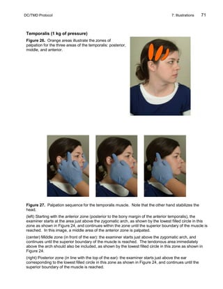 DC/TMD Protocol 7: Illustrations 71
Temporalis (1 kg of pressure)
Figure 26. Orange areas illustrate the zones of
palpation for the three areas of the temporalis: posterior,
middle, and anterior.
Figure 27. Palpation sequence for the temporalis muscle. Note that the other hand stabilizes the
head.
(left) Starting with the anterior zone (posterior to the bony margin of the anterior temporalis), the
examiner starts at the area just above the zygomatic arch, as shown by the lowest filled circle in this
zone as shown in Figure 24, and continues within the zone until the superior boundary of the muscle is
reached. In this image, a middle area of the anterior zone is palpated.
(center) Middle zone (in front of the ear): the examiner starts just above the zygomatic arch, and
continues until the superior boundary of the muscle is reached. The tendonous area immediately
above the arch should also be included, as shown by the lowest filled circle in this zone as shown in
Figure 24.
(right) Posterior zone (in line with the top of the ear): the examiner starts just above the ear
corresponding to the lowest filled circle in this zone as shown in Figure 24, and continues until the
superior boundary of the muscle is reached.
 
