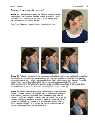 DC/TMD Protocol 7: Illustrations 72
Masseter (1 kg of palpation pressure)
Figure 28. Orange areas illustrate the zones of palpation for the
three areas of the masseter: superior, middle, and inferior. Note
that the superior zone begins just anterior to the condyle when
the mandible is in the relaxed position.
See Figure 24 legend for description of examination forms.
Figure 29. Palpation sequence for the masseter muscle while the other hand stabilizes the mandible.
(left) Origin zone (inferior to the bony margin of the zygomatic process): the examiner started at the
area just anterior to the condyle, corresponding to the filled circle in this zone as shown in Figure 24.
(center) Body zone (in front of ear lobe): start at the most posterior aspect of the muscle.
(right) Insertion zone: start at the area superior and anterior to the mandibular angle. In each zone,
the palpation continues until the anterior boundary of the muscle is reached.
Figure 30. Alternative form of palpation for the insertion of the masseter
muscle. The skin overlying the insertion area of the masseter often rolls
when applying pressure in this area. The forefinger is being used for
palpation, as shown in Figure 29 (right), while the middle finger is placed
beneath the mandibular border and held in light but firm contact. While
placing the middle finger, the skin is drown downward, thus providing a
firmer base for the forefinger to palpate the muscle and simultaneously
providing better support for the palpating hand.
 