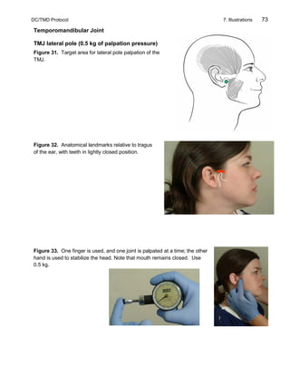DC/TMD Protocol 7: Illustrations 73
Temporomandibular Joint
TMJ lateral pole (0.5 kg of palpation pressure)
Figure 31. Target area for lateral pole palpation of the
TMJ.
Figure 32. Anatomical landmarks relative to tragus
of the ear, with teeth in lightly closed position.
Figure 33. One finger is used, and one joint is palpated at a time; the other
hand is used to stabilize the head. Note that mouth remains closed. Use
0.5 kg.
 