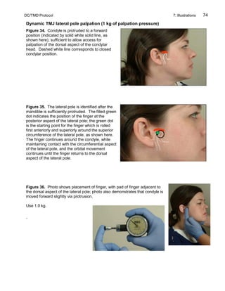 DC/TMD Protocol 7: Illustrations 74
Dynamic TMJ lateral pole palpation (1 kg of palpation pressure)
Figure 34. Condyle is protruded to a forward
position (indicated by solid white solid line, as
shown here), sufficient to allow access for
palpation of the dorsal aspect of the condylar
head. Dashed white line corresponds to closed
condylar position.
Figure 35. The lateral pole is identified after the
mandible is sufficiently protruded. The filled green
dot indicates the position of the finger at the
posterior aspect of the lateral pole; the green dot
is the starting point for the finger which is rolled
first anteriorly and superiorly around the superior
circumference of the lateral pole, as shown here.
The finger continues around the condyle, while
maintaining contact with the circumferential aspect
of the lateral pole, and the orbital movement
continues until the finger returns to the dorsal
aspect of the lateral pole.
Figure 36. Photo shows placement of finger, with pad of finger adjacent to
the dorsal aspect of the lateral pole; photo also demonstrates that condyle is
moved forward slightly via protrusion.
Use 1.0 kg.
.
 