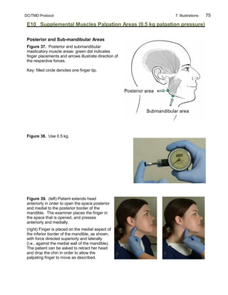 DC/TMD Protocol 7: Illustrations 75
E10 Supplemental Muscles Palpation Areas (0.5 kg palpation pressure)
Posterior and Sub-mandibular Areas
Figure 37. Posterior and submandibular
masticatory muscle areas: green dot indicates
finger placements and arrows illustrate direction of
the respective forces.
Key: filled circle denotes one finger tip.
Figure 38. Use 0.5 kg.
Figure 39. (left) Patient extends head
anteriorly in order to open the space posterior
and medial to the posterior border of the
mandible. The examiner places the finger in
the space that is opened, and presses
anteriorly and medially.
(right) Finger is placed on the medial aspect of
the inferior border of the mandible, as shown,
with force directed superiorly and laterally
(i.e., against the medial wall of the mandible).
The patient can be asked to retract her head
and drop the chin in order to allow the
palpating finger to move as described.
 