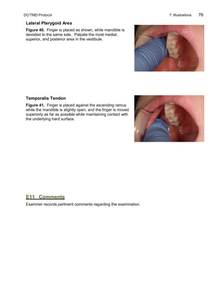 DC/TMD Protocol 7: Illustrations 76
Lateral Pterygoid Area
Figure 40. Finger is placed as shown, while mandible is
deviated to the same side. Palpate the most medial,
superior, and posterior area in the vestibule.
Temporalis Tendon
Figure 41. Finger is placed against the ascending ramus
while the mandible is slightly open, and the finger is moved
superiorly as far as possible while maintaining contact with
the underlying hard surface.
E11 Comments
Examiner records pertinent comments regarding the examination.
 