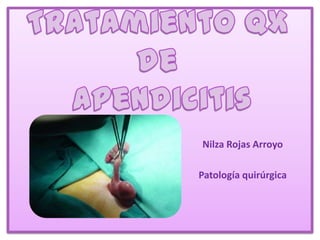 Tratamiento QX de apendicitis Nilza Rojas Arroyo Patología quirúrgica 