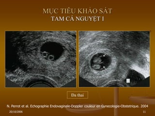 20/10/2006 11
MỤC TIÊU KHẢO SÁT
TAM CÁ NGUYỆT I
Đa thai
N. Perrot et al. Echographie Endovaginale-Doppler couleur en Gynecologie-Obstetrique. 2004
 