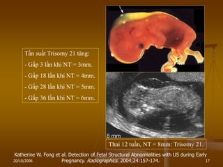 20/10/2006 17
Thai 12 tuần, NT = 8mm: Trisomy 21.
Katherine W. Fong et al. Detection of Fetal Structural Abnormalities with US during Early
Pregnancy. Radiographics. 2004;24:157-174.
Tần suất Trisomy 21 tăng:
- Gấp 3 lần khi NT = 3mm.
- Gấp 18 lần khi NT = 4mm.
- Gấp 28 lần khi NT = 5mm.
- Gấp 36 lần khi NT = 6mm.
 