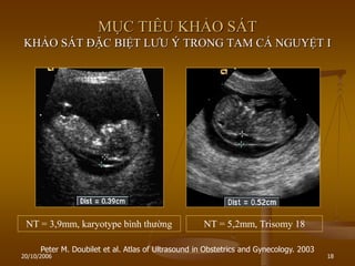 20/10/2006 18
MỤC TIÊU KHẢO SÁT
KHẢO SÁT ĐẶC BIỆT LƢU Ý TRONG TAM CÁ NGUYỆT I
NT = 3,9mm, karyotype bình thƣờng NT = 5,2mm, Trisomy 18
Peter M. Doubilet et al. Atlas of Ultrasound in Obstetrics and Gynecology. 2003
 