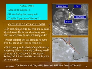 20/10/2006 19
C.M.Rumack et al. Diagnostic Ultrasound. 3rdEdition. 2005. p1039-1055
NASAL BONE
- Khảo sát từ tuần thứ 11.
- Bất sản: không thấy xƣơng mũi.
- Ý nghĩa: Nguy cơ cao Trisomy 21.
CÁCH KHẢO SÁT NASAL BONE
- Lấy mặt cắt dọc giữa mặt thai nhi, cố gắng
chỉnh hƣớng đầu dò sau cho đƣờng trán-
cằm tạo với chùm tia siêu âm một góc 450.
- Phóng đại hình ảnh sao cho đầu và ngực
trên thai nhi chiếm toàn bộ màn hình.
- Bình thƣờng ta thấy hai đƣờng hồi âm dày
song song (dấu =: equal sign); đƣờng trên là
da vùng mũi, đƣờng dƣới là xƣơng mũi.
Đƣờng thứ 3 ở cao hơn liên tục với da, đó là
chóp mũi (tip).
 