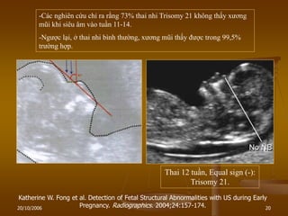 20/10/2006 20
Thai 12 tuần, Equal sign (-):
Trisomy 21.
Katherine W. Fong et al. Detection of Fetal Structural Abnormalities with US during Early
Pregnancy. Radiographics. 2004;24:157-174.
-Các nghiên cứu chỉ ra rằng 73% thai nhi Trisomy 21 không thấy xƣơng
mũi khi siêu âm vào tuần 11-14.
-Ngƣợc lại, ở thai nhi bình thƣờng, xƣơng mũi thấy đƣợc trong 99,5%
trƣờng hợp.
 