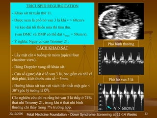 20/10/2006 23
TRICUSPID REGURGITATION
- Khảo sát từ tuần thứ 11.
- Đƣợc xem là phổ hở van 3 lá khi v > 60cm/s
và kéo dài tối thiểu nửa thì tâm thu.
(van ĐMC và ĐMP có thể đạt vmax = 50cm/s).
- Ý nghĩa: Nguy cơ cao Trisomy 21.
CÁCH KHẢO SÁT
- Lấy mặt cắt 4 buồng từ mỏm (apical four
chamber view).
- Dùng Doppler xung để khảo sát.
- Cửa sổ (gate) đặt ở lỗ van 3 lá, bao gồm cả nhĩ và
thất phải, kích thƣớc cửa sổ = 3mm.
- Đƣờng khảo sát tạo với vách liên thất một góc <
300 (góc lý tƣởng là 00).
Phổ bình thƣờng
Phổ hở van 3 lá
V > 60cm/s
Fetal Medicine Foundation - Down Syndrome Screening at 11-14 Weeks
Các nghiên cứu chỉ ra rằng hở van 3 lá thấy ở 74%
thai nhi Trisomy 21, trong khi ở thai nhi bình
thƣờng chỉ thấy trong 7% trƣờng hợp.
 