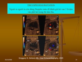 20/10/2006 24
Greggory R. DeVore, MD. Fetal Echocardiography. 2005
TRICUSPID REGURGITATION
Ngoài ra ngƣời ta còn dùng Doppler màu để đánh giá hở van 3 lá dựa
vào phổ hở trong thì tâm thu.
 
