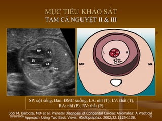 20/10/2006 36
Jodi M. Barboza, MD et al. Prenatal Diagnosis of Congenital Cardiac Anomalies: A Practical
Approach Using Two Basic Views. Radiographics. 2002;22:1125-1138.
MỤC TIÊU KHẢO SÁT
TAM CÁ NGUYỆT II & III
SP: cột sống, Dao: ĐMC xuống, LA: nhĩ (T), LV: thất (T),
RA: nhĩ (P), RV: thất (P).
 