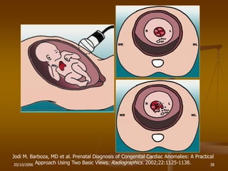 20/10/2006 38
Jodi M. Barboza, MD et al. Prenatal Diagnosis of Congenital Cardiac Anomalies: A Practical
Approach Using Two Basic Views. Radiographics. 2002;22:1125-1138.
 