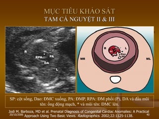 20/10/2006 40
Jodi M. Barboza, MD et al. Prenatal Diagnosis of Congenital Cardiac Anomalies: A Practical
Approach Using Two Basic Views. Radiographics. 2002;22:1125-1138.
MỤC TIÊU KHẢO SÁT
TAM CÁ NGUYỆT II & III
SP: cột sống, Dao: ĐMC xuống, PA: ĐMP, RPA: ĐM phổi (P), DA và đầu mũi
tên: ống động mạch, * và mũi tên: ĐMC lên.
 