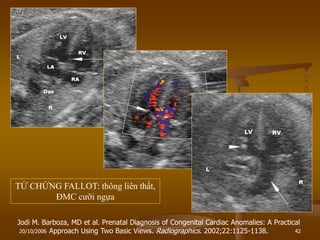 20/10/2006 42
Jodi M. Barboza, MD et al. Prenatal Diagnosis of Congenital Cardiac Anomalies: A Practical
Approach Using Two Basic Views. Radiographics. 2002;22:1125-1138.
TỨ CHỨNG FALLOT: thông liên thất,
ĐMC cƣỡi ngựa
 