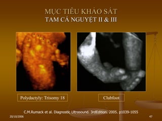 20/10/2006 47
MỤC TIÊU KHẢO SÁT
TAM CÁ NGUYỆT II & III
Polydactyly: Trisomy 18
C.M.Rumack et al. Diagnostic Ultrasound. 3rdEdition. 2005. p1039-1055
Clubfoot
 