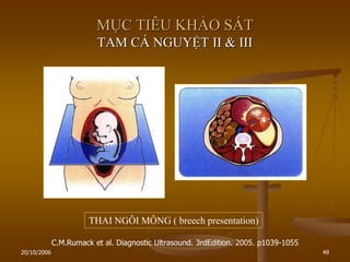 20/10/2006 49
MỤC TIÊU KHẢO SÁT
TAM CÁ NGUYỆT II & III
C.M.Rumack et al. Diagnostic Ultrasound. 3rdEdition. 2005. p1039-1055
THAI NGÔI MÔNG ( breech presentation)
 