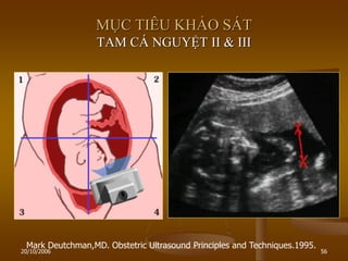 20/10/2006 56
MỤC TIÊU KHẢO SÁT
TAM CÁ NGUYỆT II & III
Mark Deutchman,MD. Obstetric Ultrasound Principles and Techniques.1995.
 