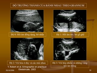 20/10/2006 59
Y. Robert et al. Echographie en practique
Obstetricale. 2003
ĐỘ TRƢỞNG THÀNH CỦA BÁNH NHAU THEO GRANNUM
Độ 0: Hồi âm đồng dạng, bờ nhẵn Độ 1: Hồi âm thô, bờ gồ ghề
Độ 2: Vôi hóa ở đáy và các múi nhau Độ 3: Vôi hóa nhiều và những vùng
hồi âm trống
 