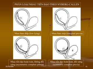20/10/2006 61
PHÂN LOẠI NHAU TIỀN ĐẠO THEO NYBERG-CALLEN
Nhau bám thấp (low-lying) Nhau bám mép (marginal previa)
Nhau tiền đạo hoàn toàn, không đối
xứng (asymmetric complete previa)
Nhau tiền đạo hoàn toàn, đối xứng
(symmetric complete previa)
 